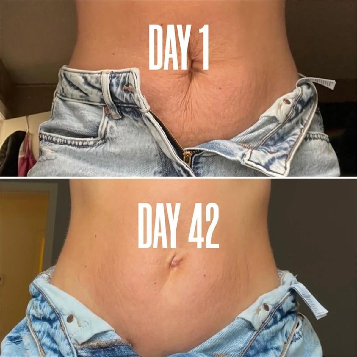 Dehnungsstreifen-Creme | 2 + 1 GRATIS | Bündeln